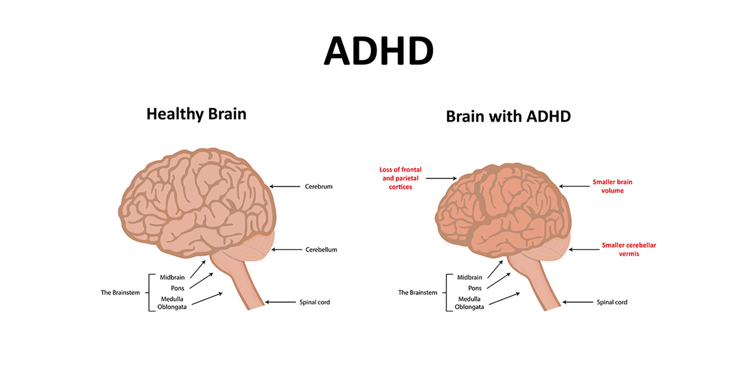 Adhd Brain Structure